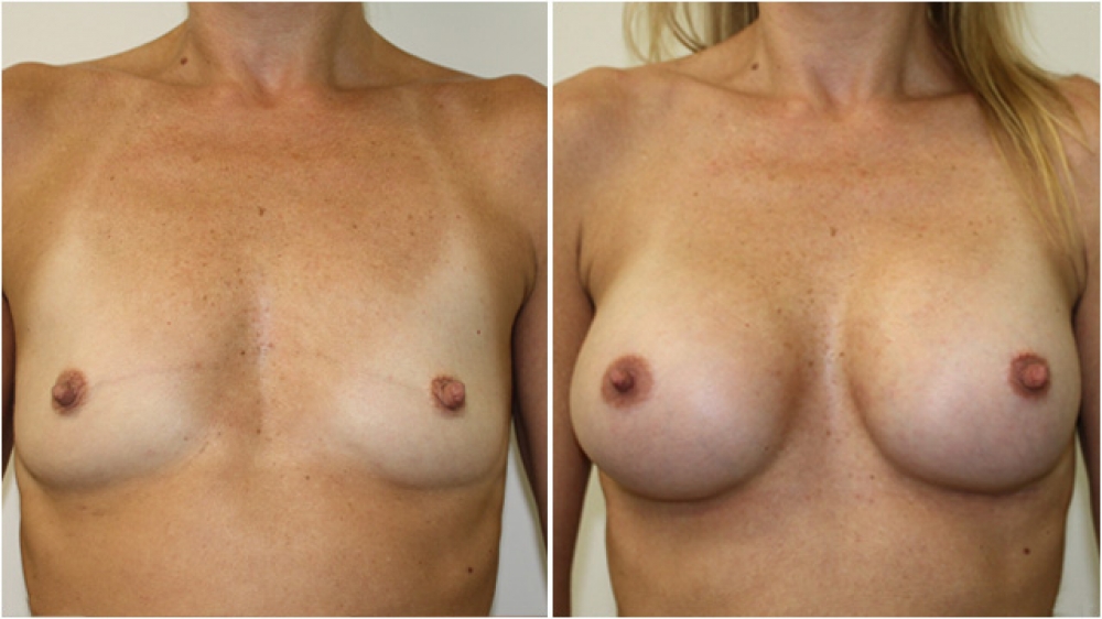 Early 30s, athletic, no children, 255g anatomical (teardrop) moderate profile implants, dual plane 2 placement, AA -> C cup.