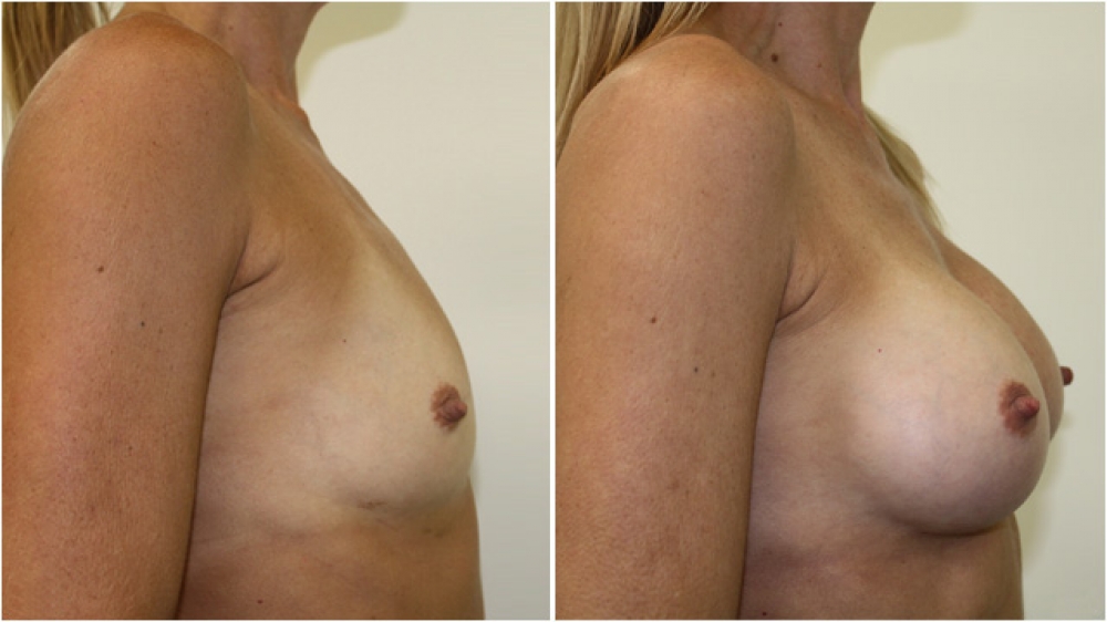 Early 30s, athletic, no children, 255g anatomical (teardrop) moderate profile implants, dual plane 2 placement, AA -> C cup.