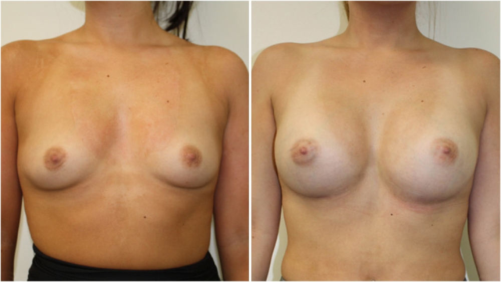 Early 20s, no children, 385g round, high profile textured implants, dual plane 2 placement, B -> D cup.