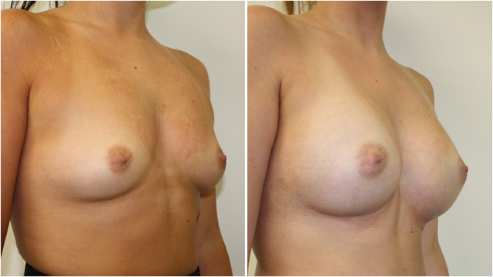 Early 20s, no children, 385g round, high profile textured implants, dual plane 2 placement, B -> D cup.