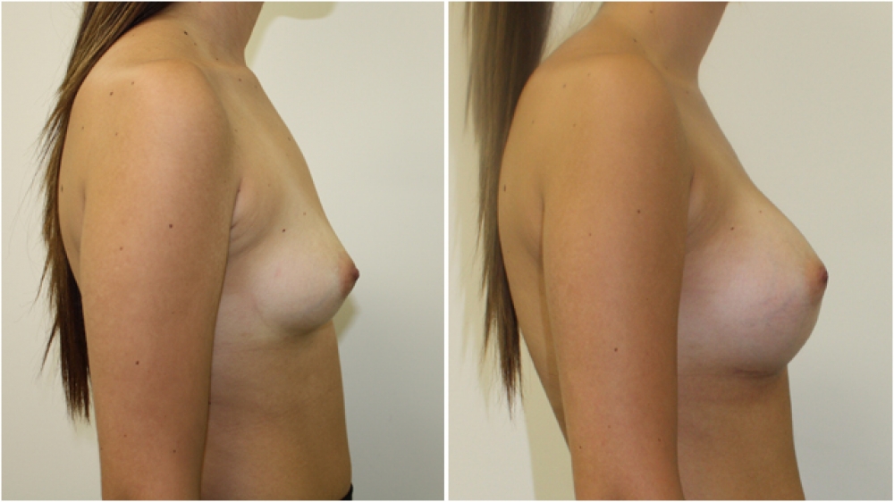 18 yo female, dual-plane 2 submuscular breast augmentation, 350cc textured round breast implants, A cup -> D cup.