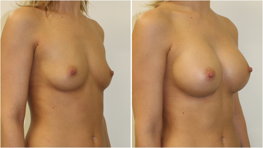 Late 20s, no children, 360g anatomic (teardrop), extra full projection implants, dual plane 3 placement. A cup -> D cup.