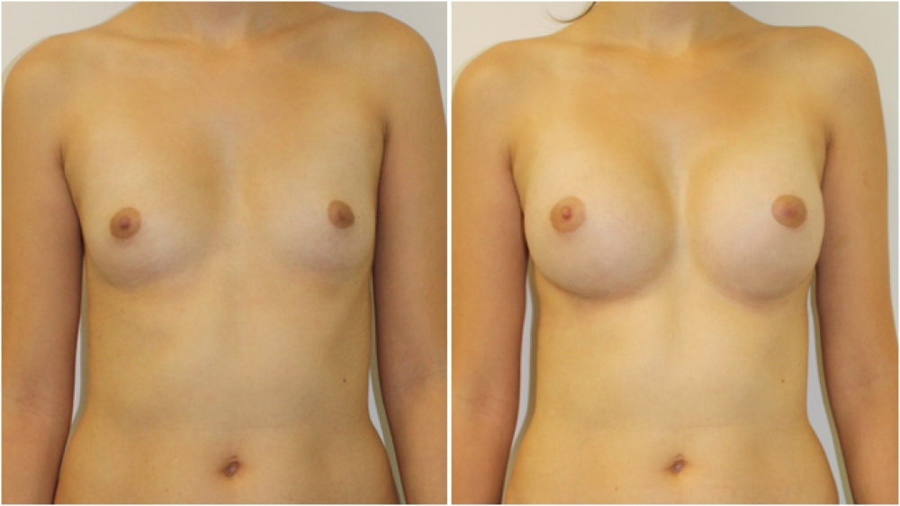 Late 20s, no children, 280cc round, high profile implants, dual plane 2 placement. A -> C cup.