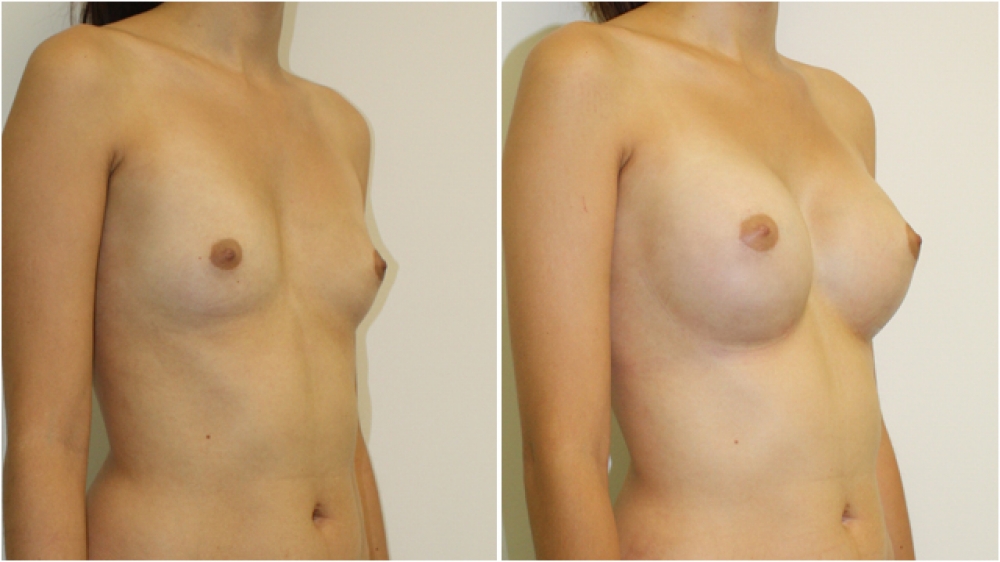 Late 20s, no children, 280cc round, high profile implants, dual plane 2 placement. A -> C cup.