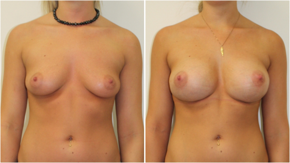 Early 20s, no children, 295g anatomical (teardrop) moderate profile implants, dual plane 2 placement, B>D cup