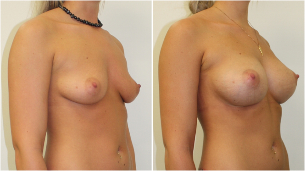 Early 20s, no children, 295g anatomical (teardrop) moderate profile implants, dual plane 2 placement, B>D cup