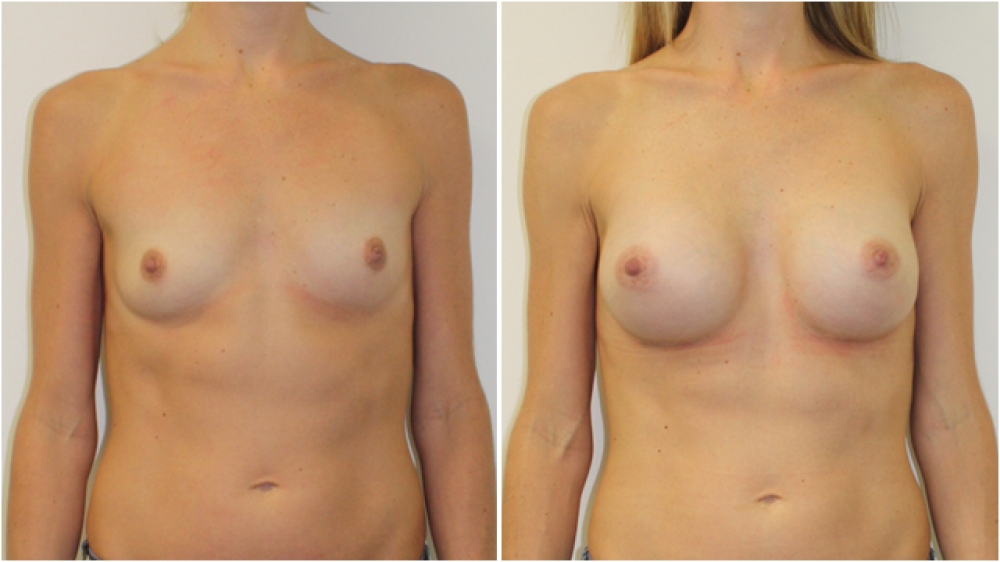 30s, no children, 375g anatomical (teardrop) high profile implants dual plane 3 placement A -> Full C cup.