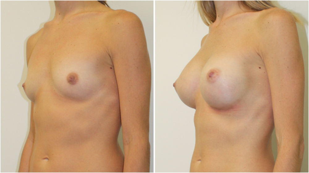 30s, no children, 375g anatomical (teardrop) high profile implants dual plane 3 placement A -> Full C cup.