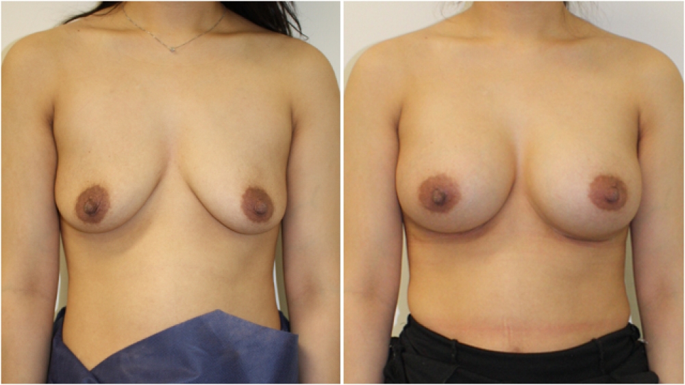Late 20s, two children, moderate droop, 325g anatomical (teardrop) high profile implants, dual plane 3 placement, natural looking A -> full C cup.