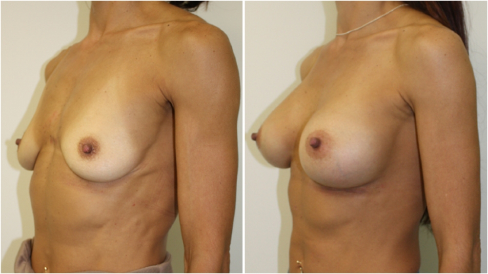 Mid 40s, athletic patient, three children, 325g anatomical (teardrop) high profile implants, dual plane 3 placement, small B -> full C cup.