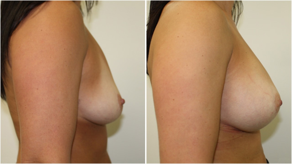 Mid 40s, children, 270g anatomical (teardrop) moderate profile implants, subfascial placement, natural looking B -> D cup.