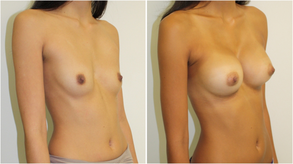 Mid 20s,no children, 315g anatomic moderate profile implants, dual plane 2 placement. B ->D cup.