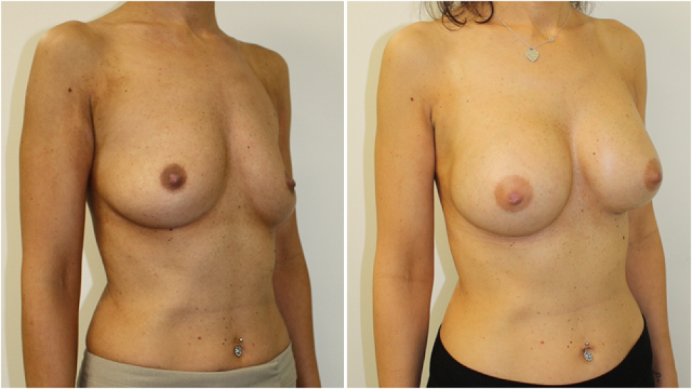 Late 30s, no children, 360g anatomic high profile implants, dual plane 3 placement. B -> DD cup.