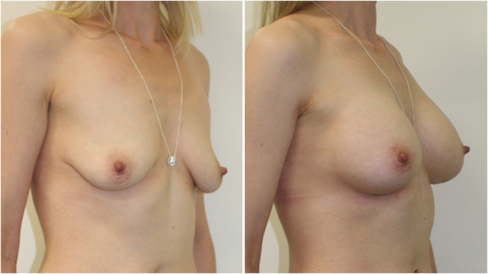 Early 30s, one child, 360g anatomical (teardrop) extra high profile implants, dual plane 3 placement, B > D cup.