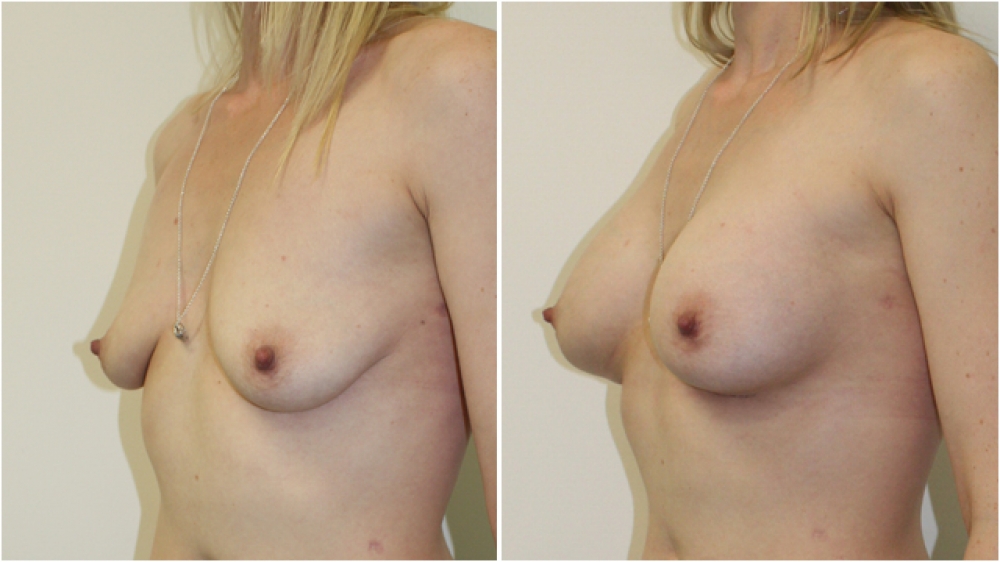 Early 30s, one child, 360g anatomical (teardrop) extra high profile implants, dual plane 3 placement, B > D cup.