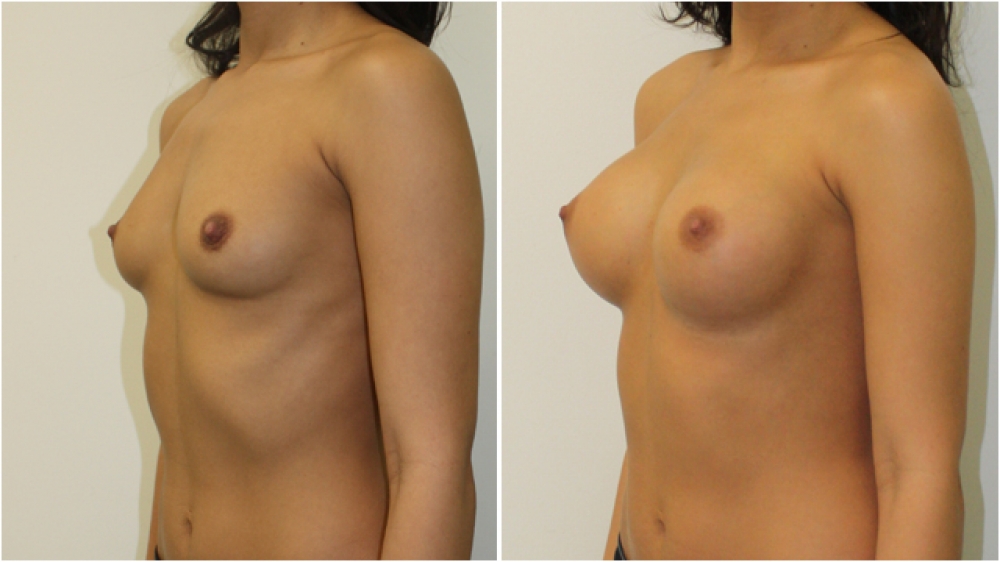 21 years old, no children, 215cc round high profile implants, dual plane 2 placement. B- > full C cup.