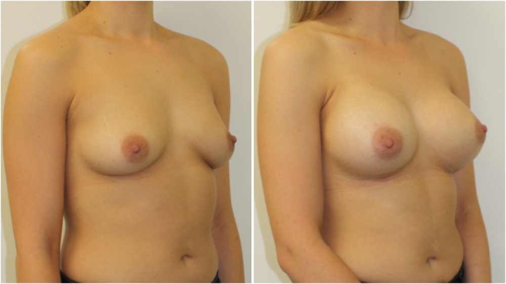 20s, no children, 290 g anatomical (teardrop) moderate profile implants, dual plane 3 placement. A -> C cup.