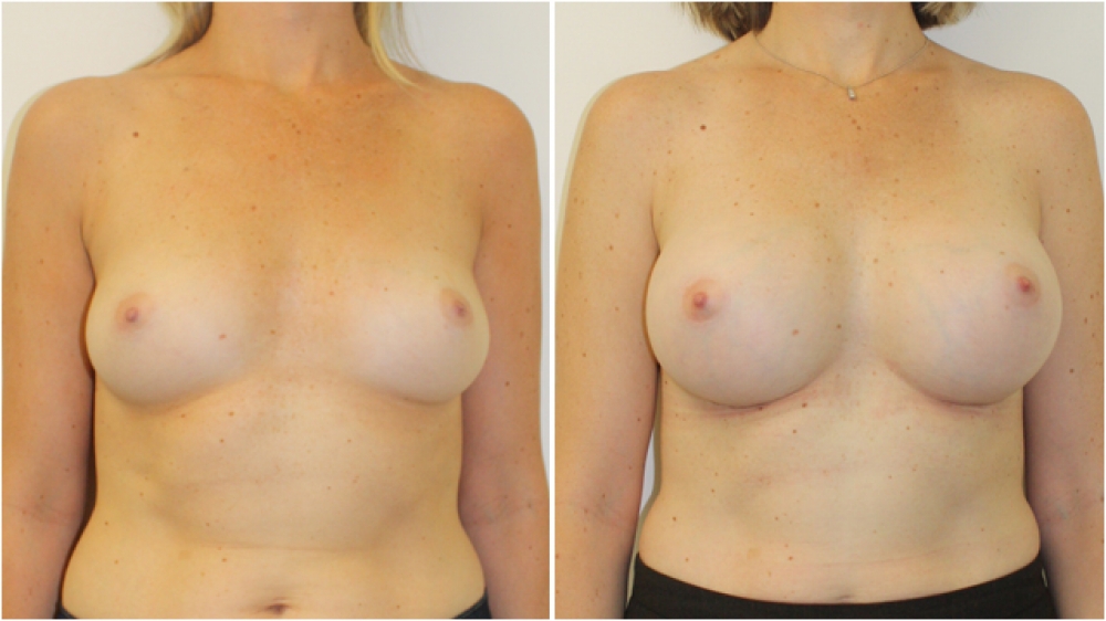 Early 30s, no children, 335g anatomical (teardrop) high profile implants, dual plane 2 placement. B -> D cup.