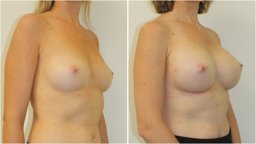 Early 30s, no children, 335g anatomical (teardrop) high profile implants, dual plane 2 placement. B -> D cup.