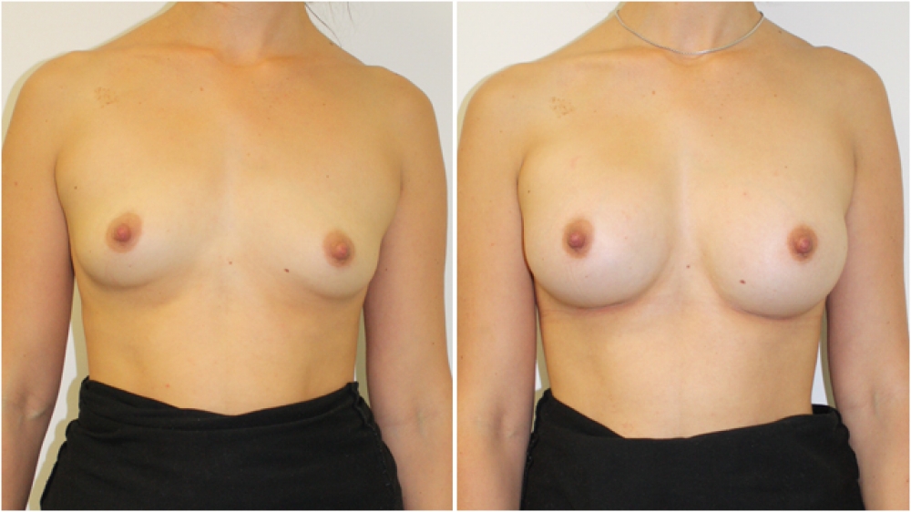 Early 20s, no children, 235g anatomical (teardrop) moderate profile implants, dual plane 2 placement. A -> C cup.