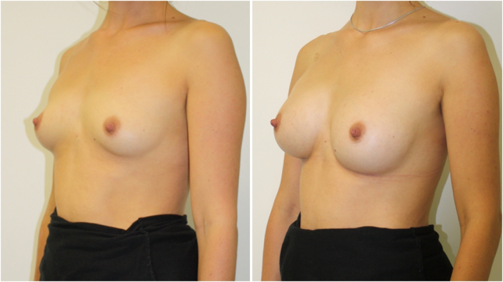 Early 20s, no children, 235g anatomical (teardrop) moderate profile implants, dual plane 2 placement. A -> C cup.