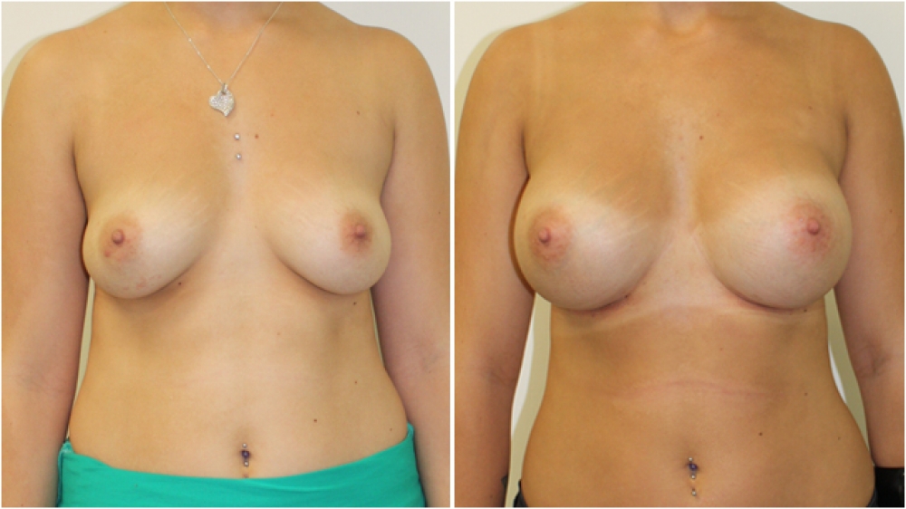 Early 20s, no children, 280cc round, high profile implants, subglandular placement. C cup > D cup.