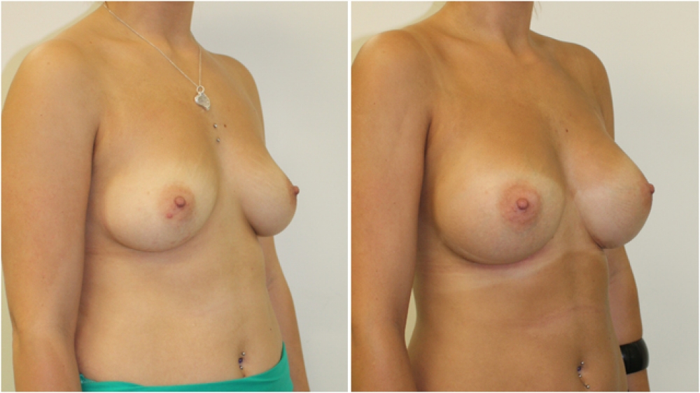 Early 20s, no children, 280cc round, high profile implants, subglandular placement. C cup > D cup.