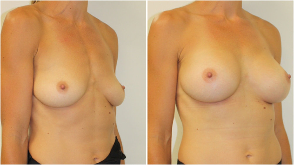 Early 30s, no children, 310g anatomic (teardrop) moderate profile implants, dual plane 2 placement. B -> D cup.