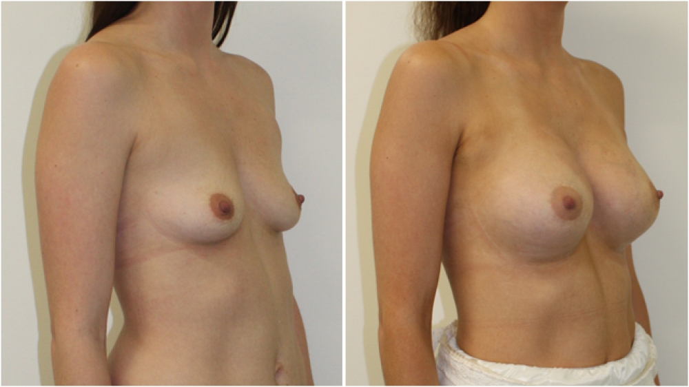 20s, two children, 360g anatomical extra high profile implants, dual plane 2 placement. A -> D cup.