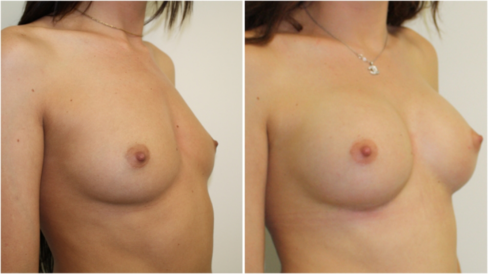 Early 20s, no children, 290g anatomical high profile implants, dual plane 2 placement. B -> Full C cup.