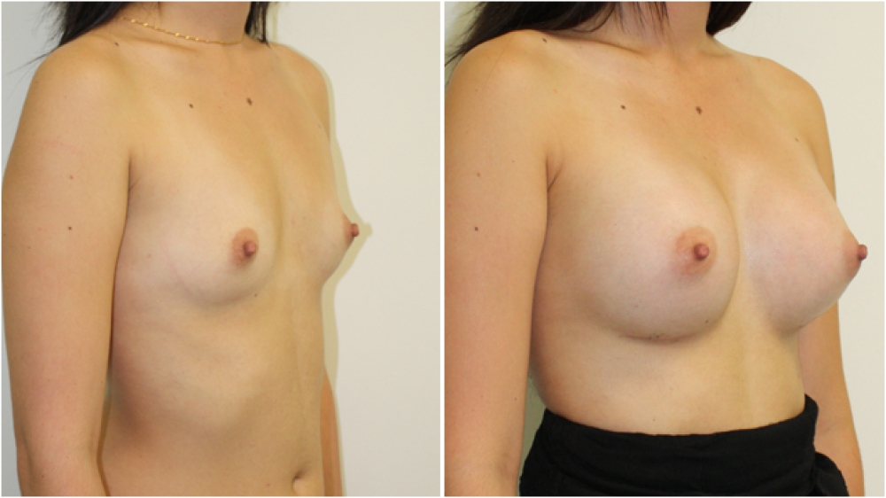 20 yo, no children, 335cc round high profile implants, dual plane 2 placement. A > Full C cup.