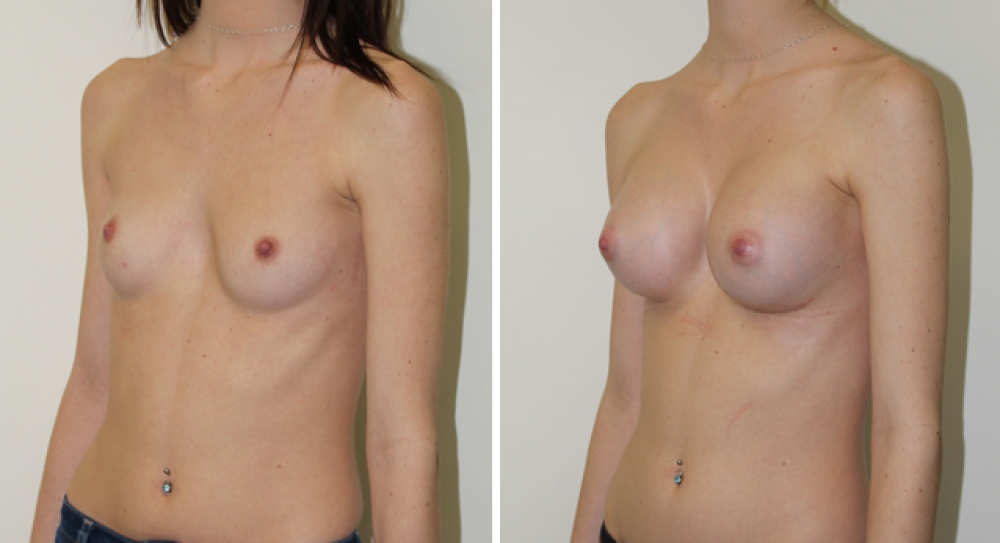 Early 20s, no children, 315g moderate profile anatomic (teardrop) P-URE implants, dual plane 1 placement.
