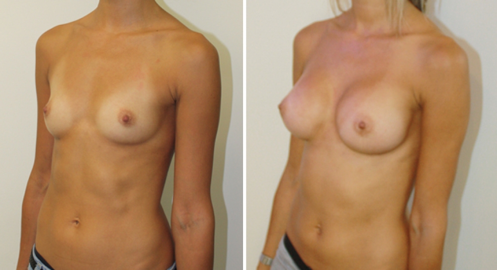 29 years old, no children, 225g high profile anatomic (teardrop) implants, dual plane 1 placement.