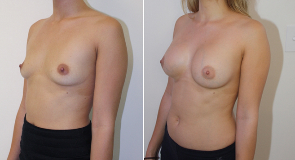 Early 20s, 1 child, dual plane 2 placement, 360g anatomical (teardrop) moderate projection implants.