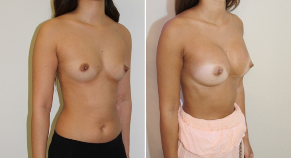 Late 20's, no children, breast augmentation procedure performed using 360g anatomical (teardrop) implants, dual plane 1 placement.