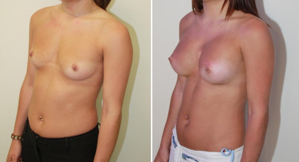 19 yo, 163cm, no children, 410g anatomical (teardrop) high profile implants, dual plane 2 placement.