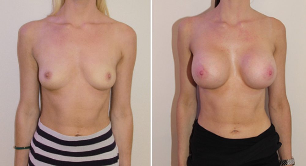 Mid 20s, no children, 445g round implants, submuscular placement.