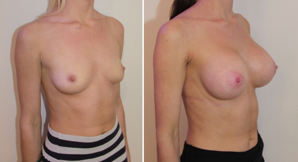 Mid 20s, no children, 445g round implants, submuscular placement.