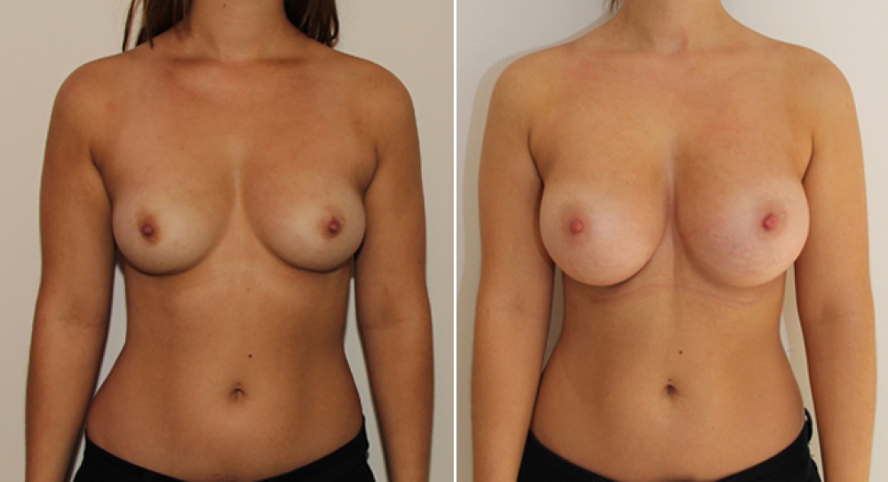 Late 20s, no children, breast augmentation performed, using 390g round implants, subfascial placement.