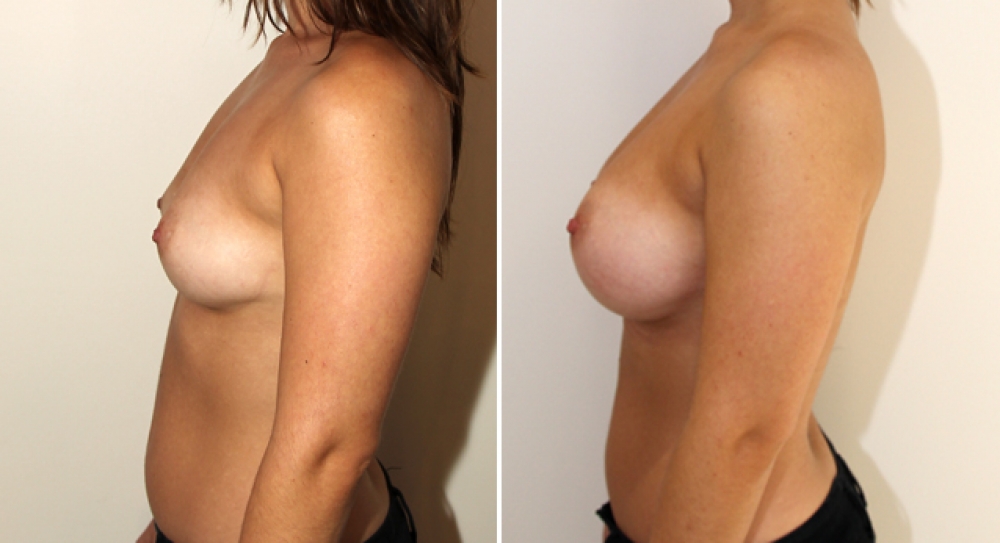 Late 20s, no children, breast augmentation performed, using 390g round implants, subfascial placement.
