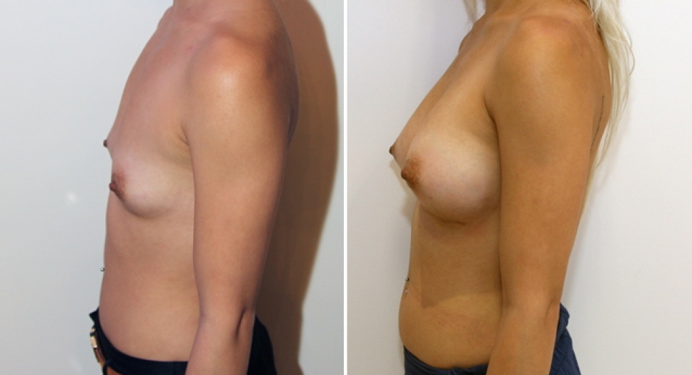 20 yo, no children, breast augmentation performed using 350g textured anatomical (teardrop) implants with dual plane 2 placement.