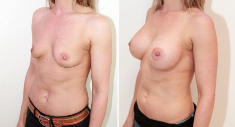 39 yo, 6 children, breast augmentation performed using 315g anatomical (teardrop) implants with dual plane 3 placement.