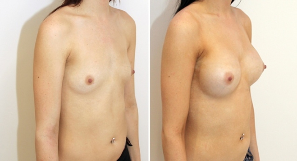 21yo, no children, breast augmentation performed using 295g anatomical (teardrop) implants with dual plane 2 placement.