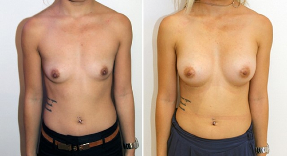 20 yo, no children, breast augmentation performed using 350g anatomical (teardrop) implants with dual plane 2 placement.