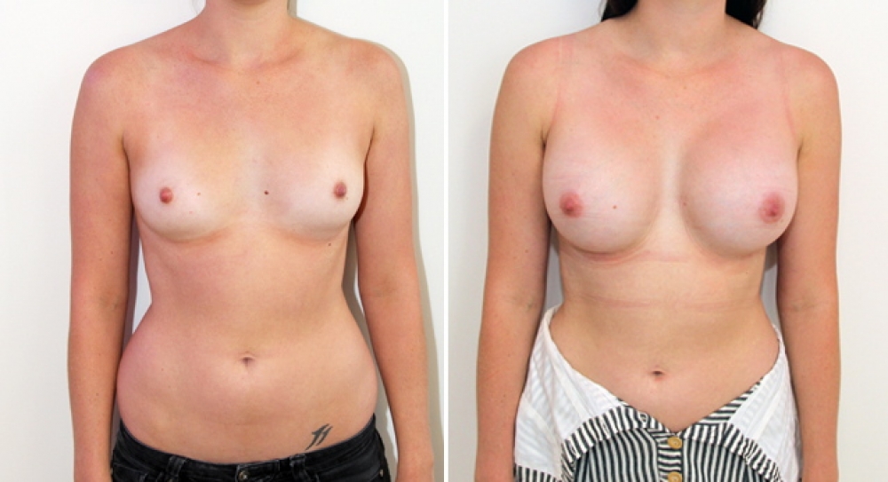 28 yo, no children, breast augmentation performed using 375g anatomical (teardrop) implants using dual plane 3 placement.