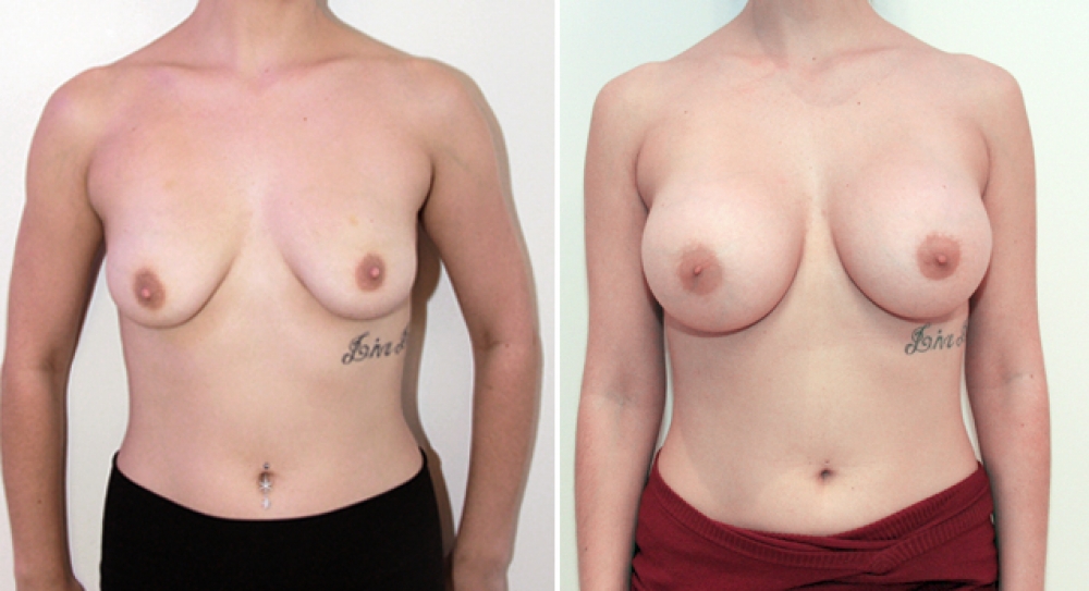 Mid 20s, breast augmentation procedure performed using 390g anatomical (teardrop) implants with subfascial placement.