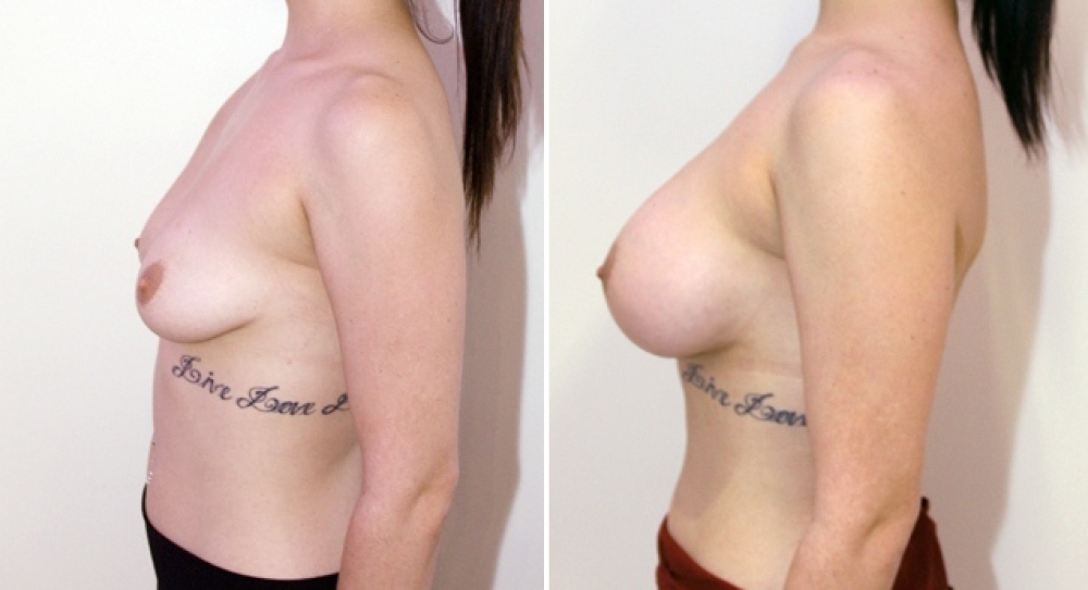 Mid 20s, breast augmentation procedure performed using 390g anatomical (teardrop) implants with subfascial placement.