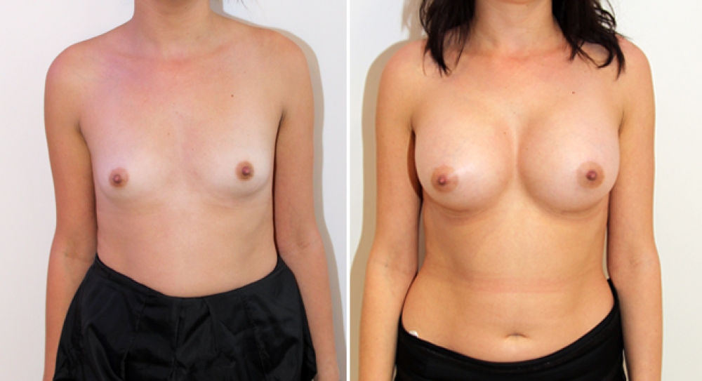 30 yo, no children, breast augmentation performed using 375g anatomical (teardrop) implants with dual plane 2 placement.