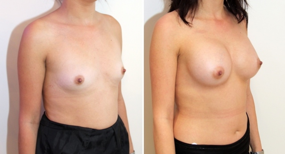 30 yo, no children, breast augmentation performed using 375g anatomical (teardrop) implants with dual plane 2 placement.