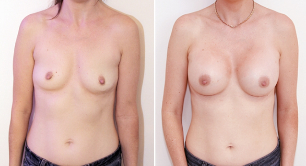 Mid 30's, 2 children, breast augmentation performed using 425g anatomical (teardrop) implants with dual plane 2 placement.